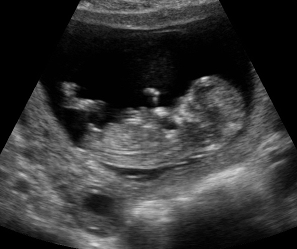 unborn boy baby ultrasound
