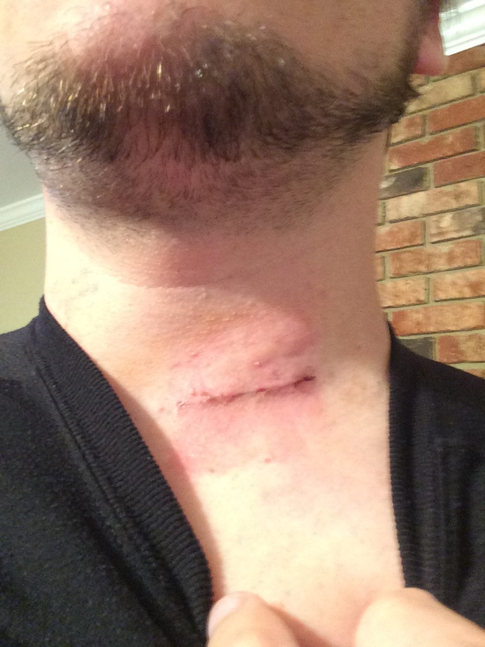 Perspective Through Pain: Mark Brunke's neck surgery story