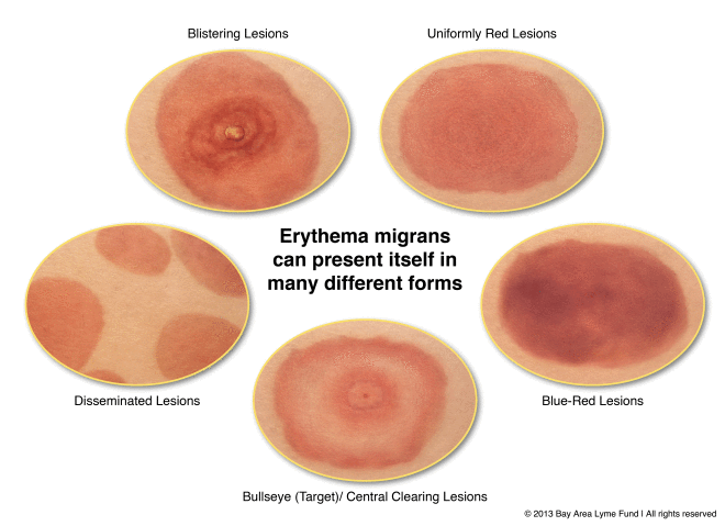 Erythema migrans can present itself in many forms.